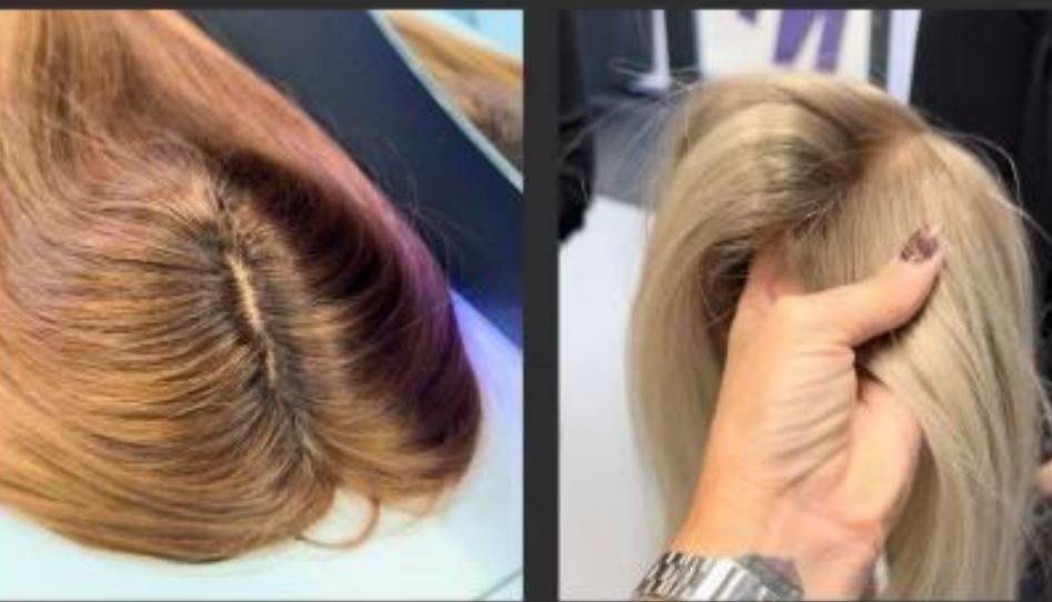 Signature Scalp Installation