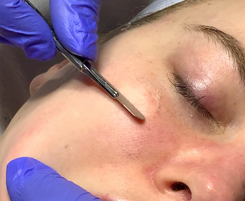 Dermaplaning Facial