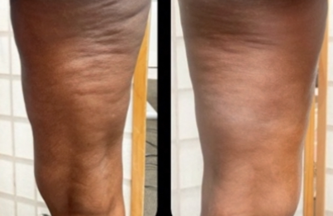 Cellulite Removal 1 session