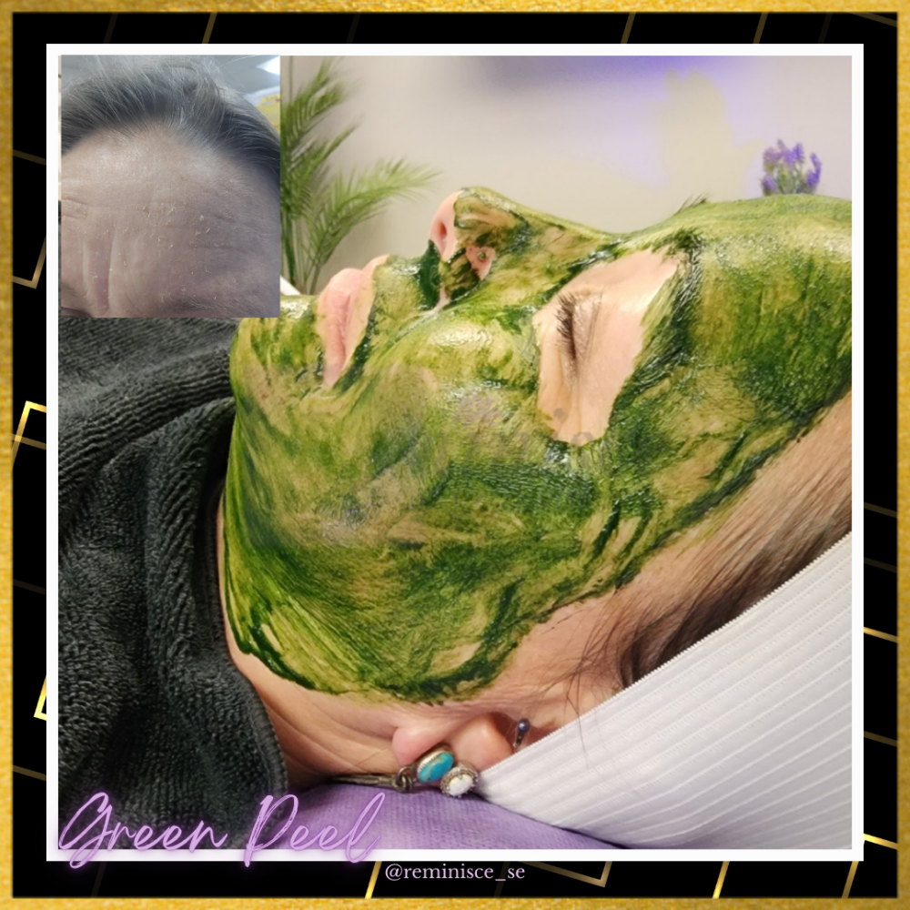 Green Peel (Liquid Microneedling)