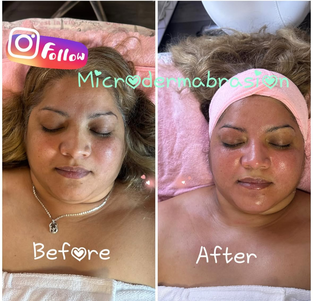 Microdermabrasion