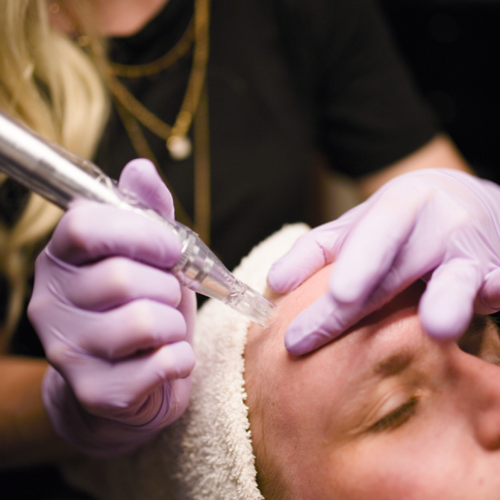 Microneedling at Timeless Glow in Eagar, AZ