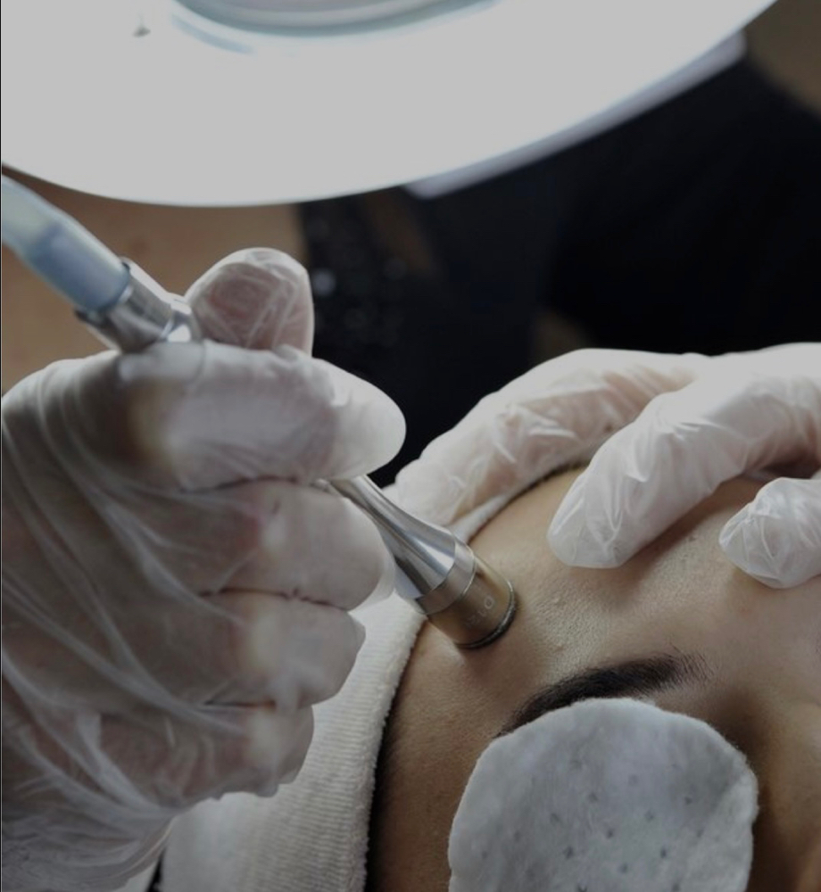Microdermabrasion