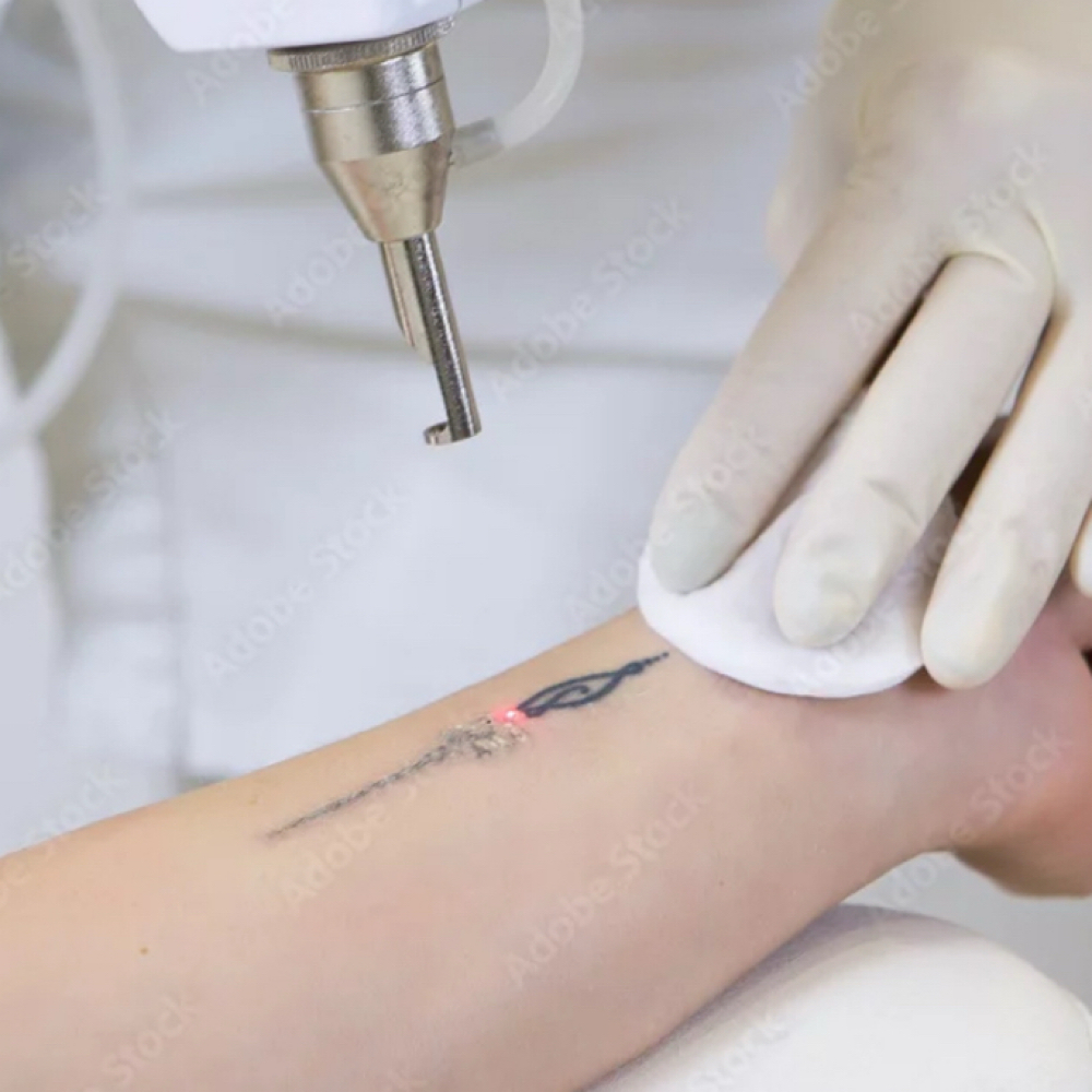 Laser Tattoo Removal at Evolve Wellness and Aesthetics in Vidalia, GA