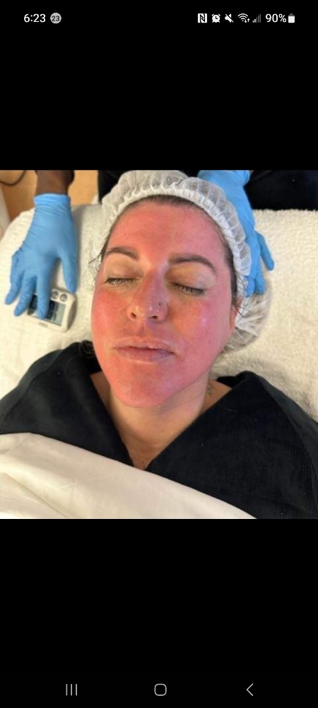 Micro- Needling (Bella) - Face