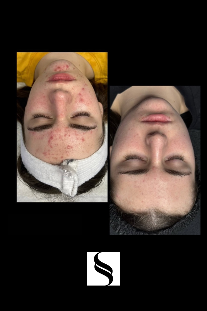 Summer Safe Peels + Pigment Control