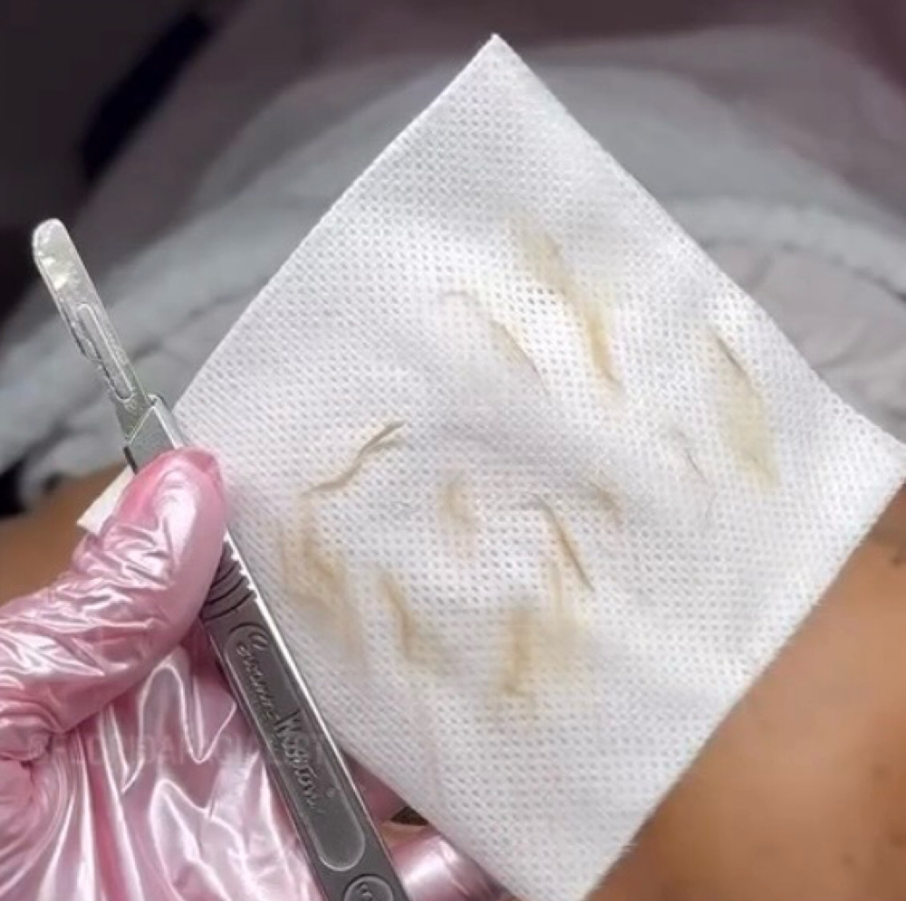 Dermaplaning Treatment