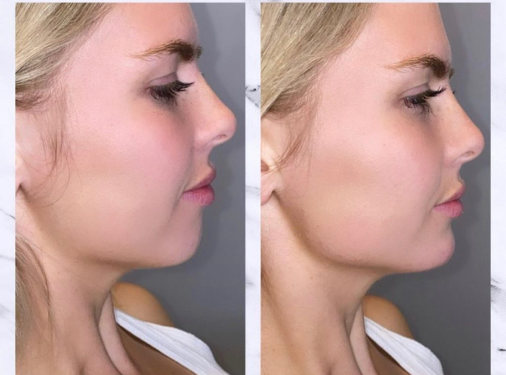 Jaw Line Filler
