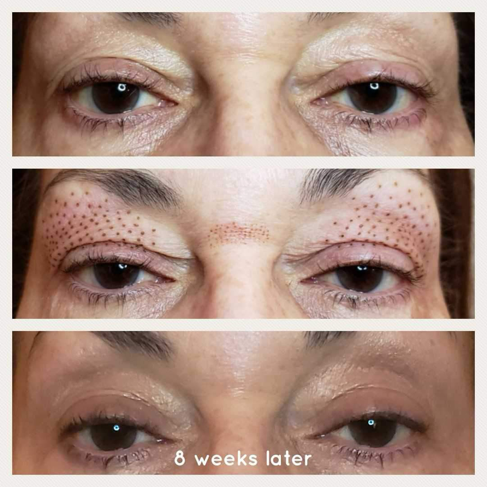 Plasma Fibroblast Eyelid Lift