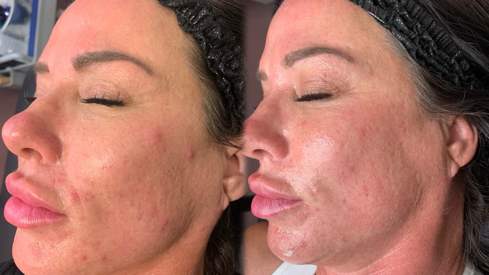 Acne Facial