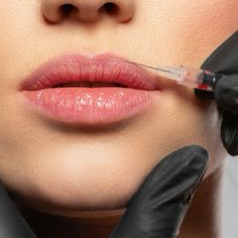 Lip Flip Add-on at Face Haus Aesthetics in Colorado Springs, CO