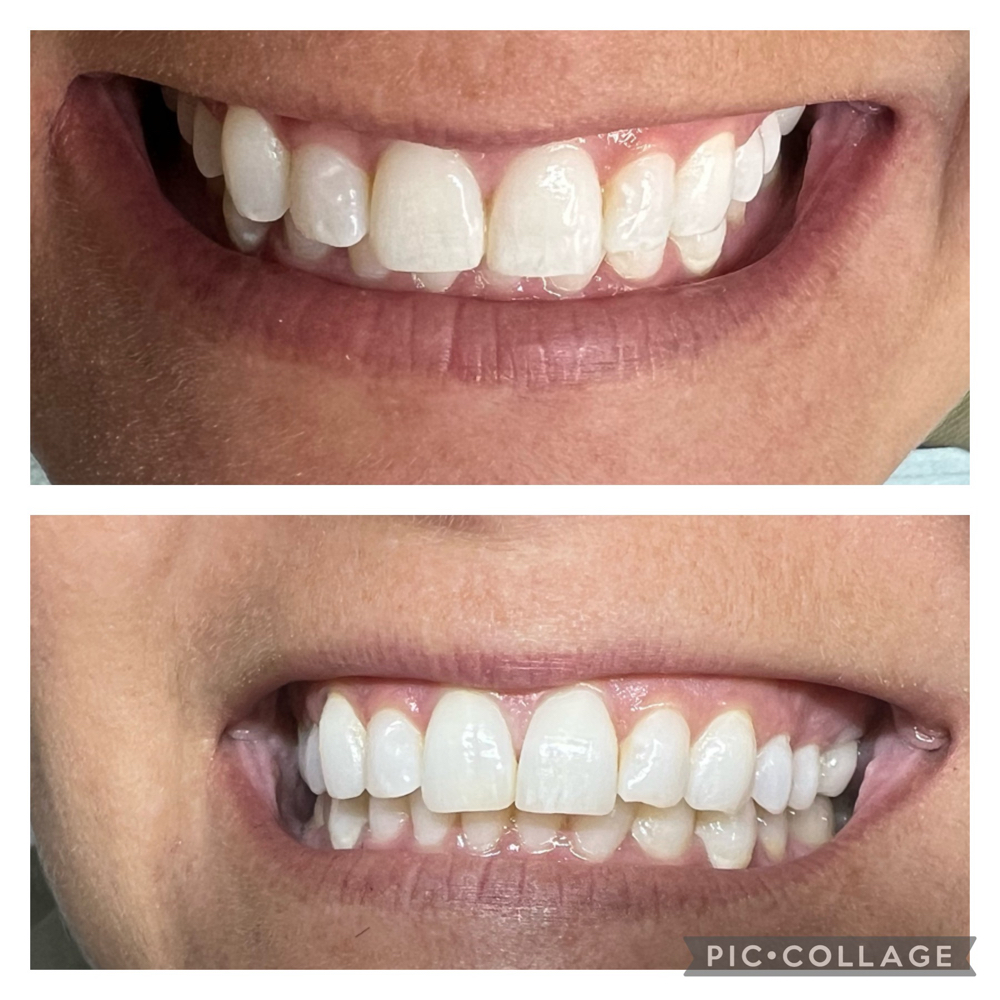 Whitening Package (6 Sessions)