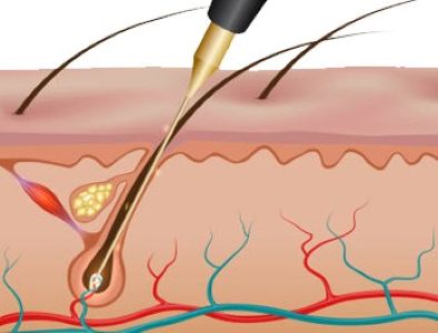 Electrolysis 30 Minutes
