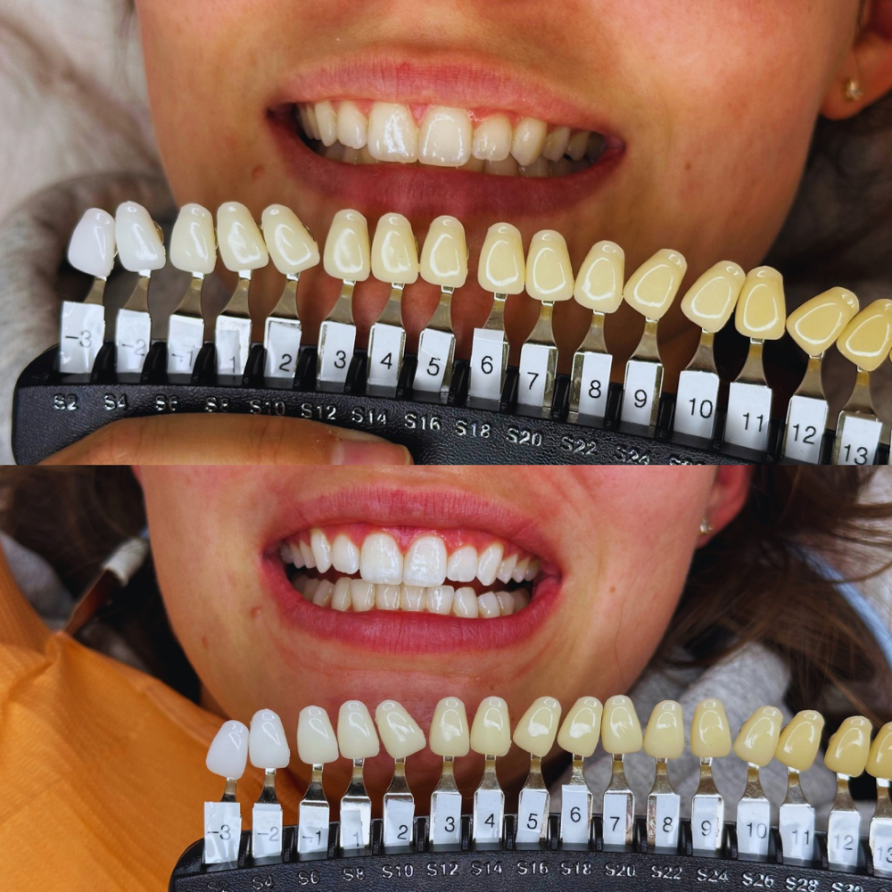 Teeth Whitening Touch Up