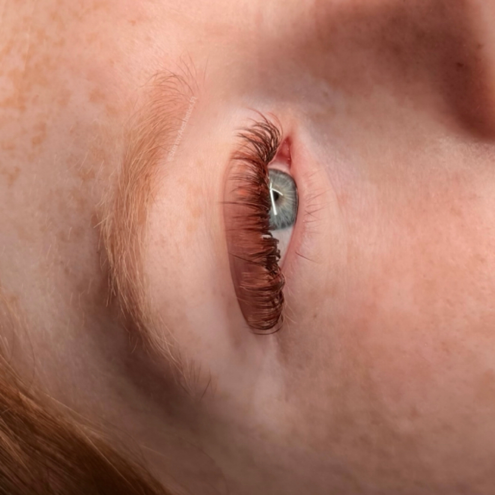 Color Match Fill at Stormy Aesthetics in Clearwater, FL