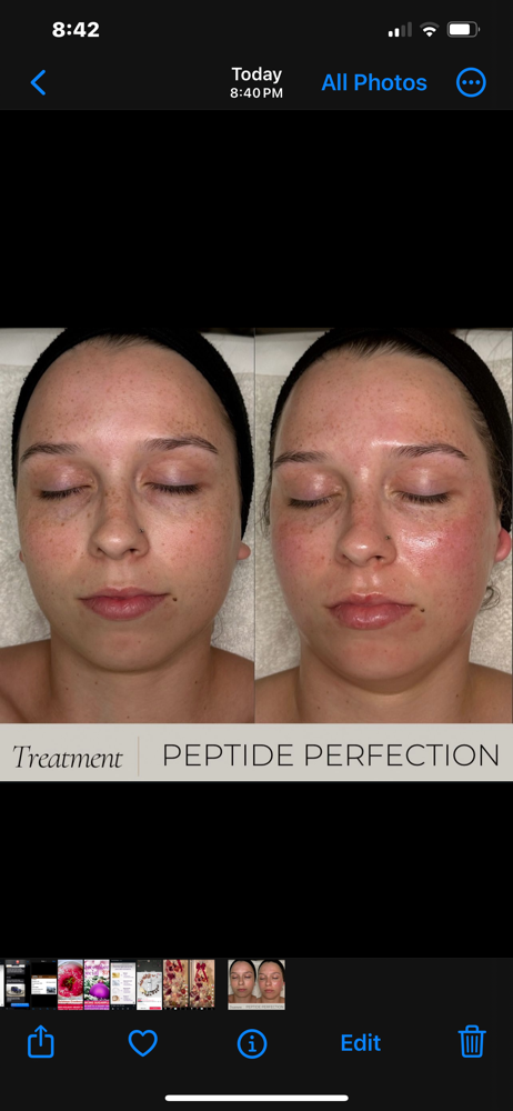 Peptide Renewal Superficial Peel