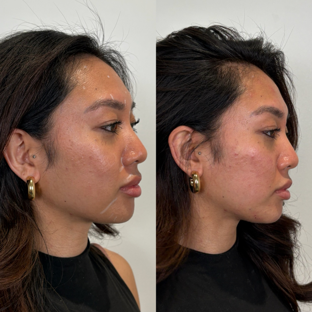 Profile Balancing at Atelier Aesthetics and Infusions in Dallas, TX