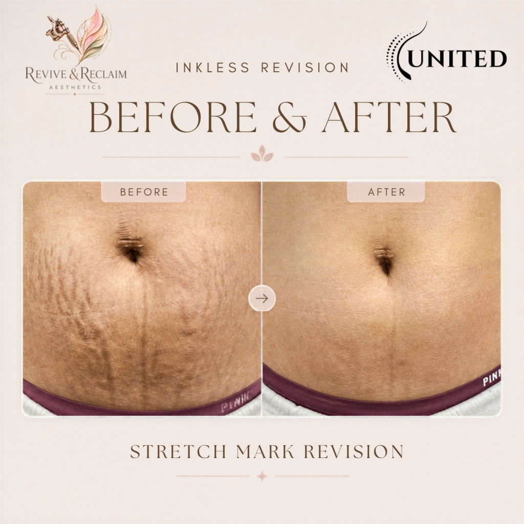 Inkless Revision Consultaion at Revive & Reclaim Aesthetics in El Cajon, CA