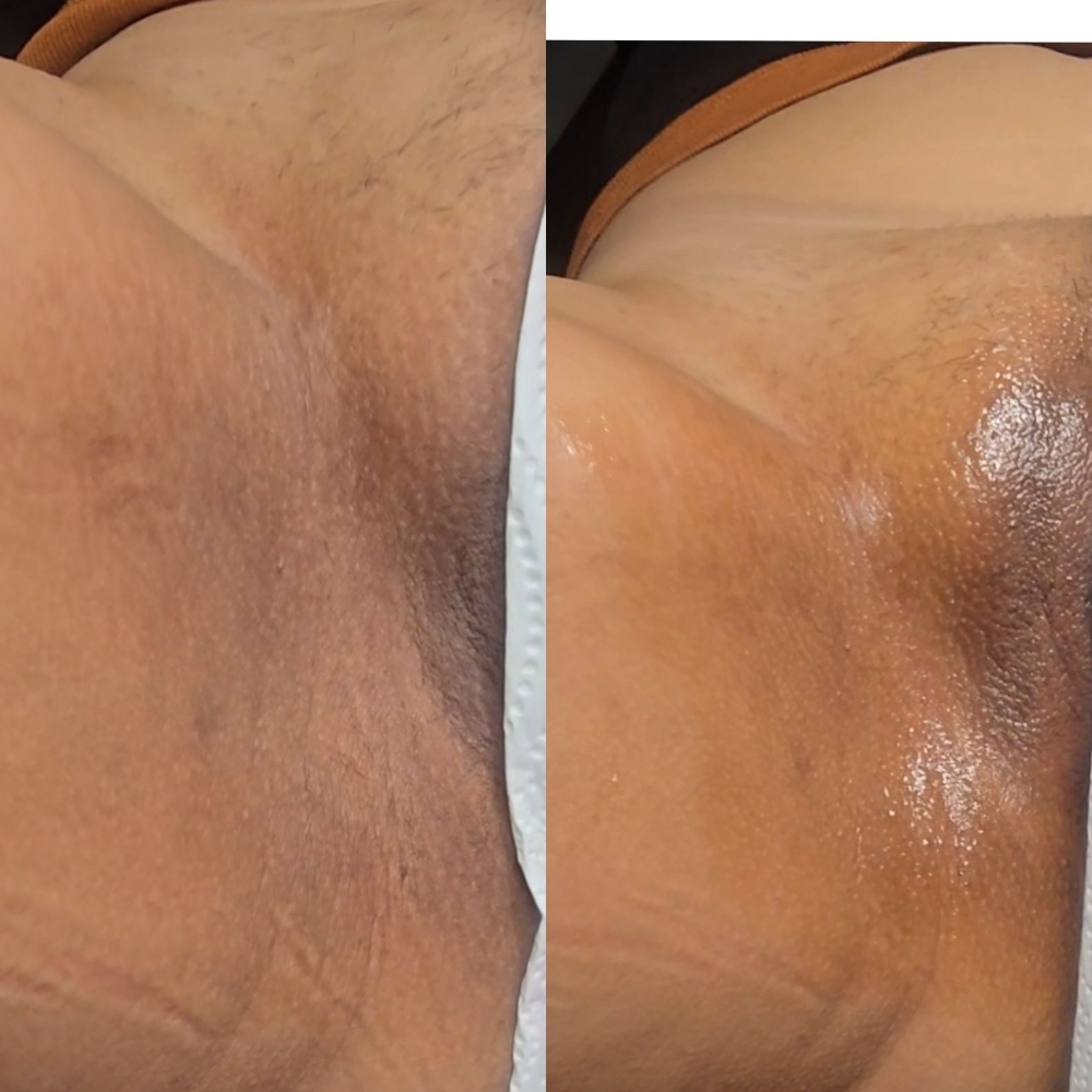 Brazilian+ Underarm Skin Correct at Pretty In Pink Beauty LLC in Ontario, CA