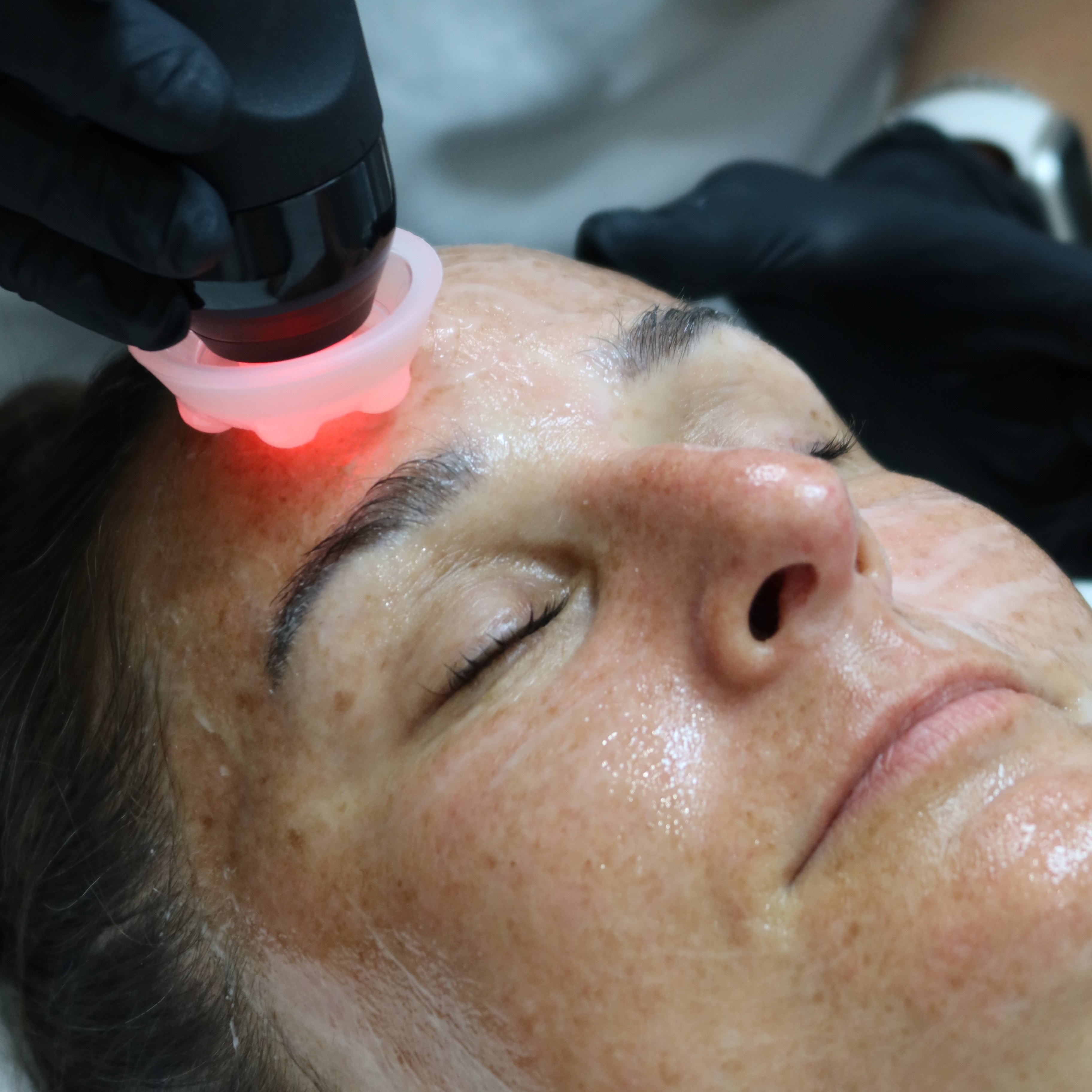 Glo2Facial Premium with RF Pro at PolinaSerene in Tenafly, NJ