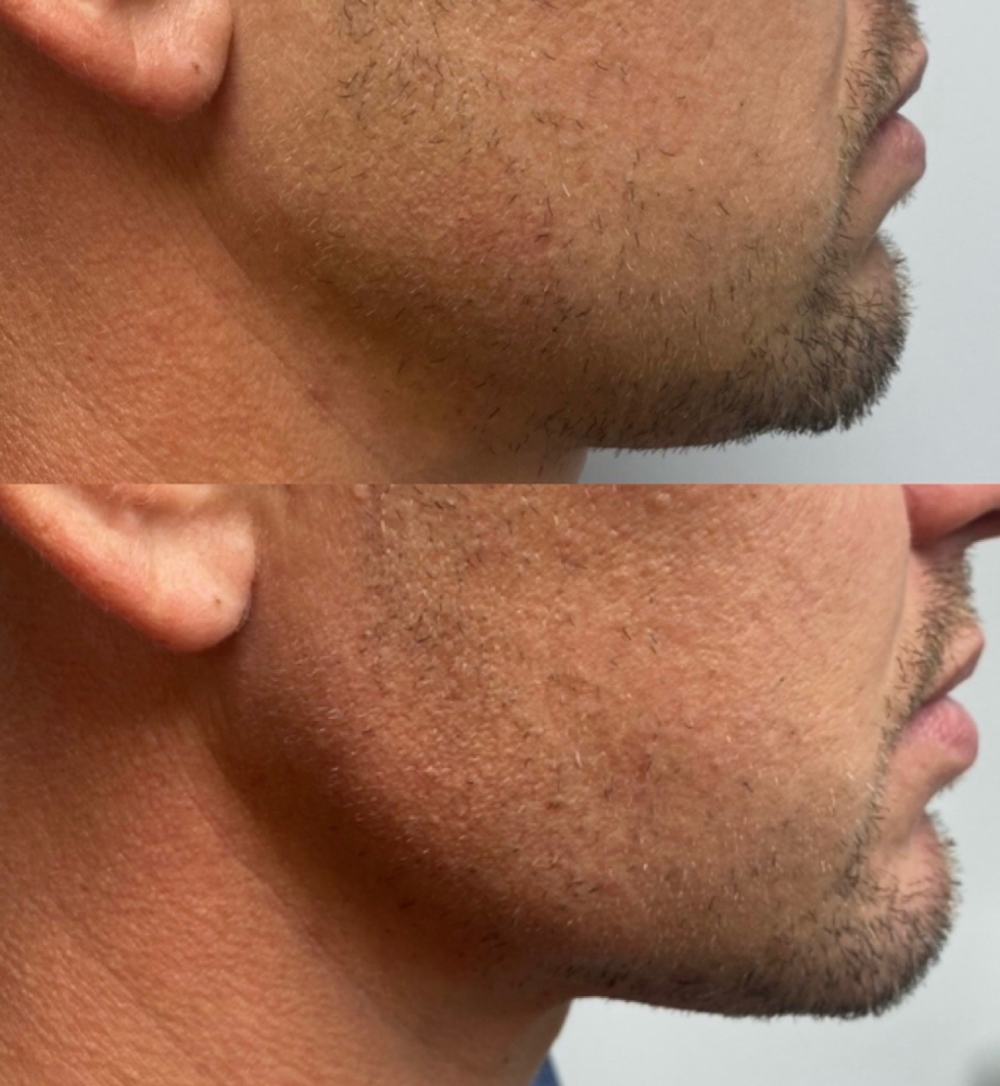 Hya Platinum Jawline Aug.