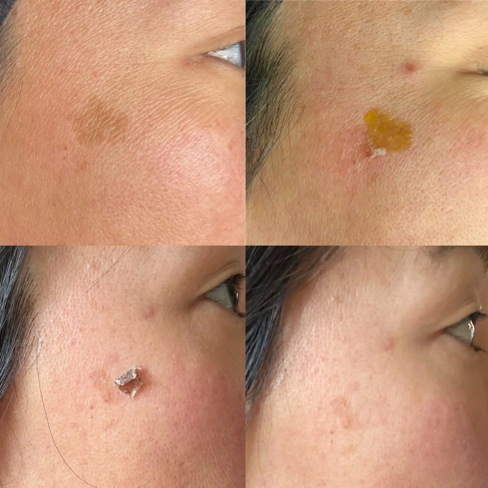 Custom Chemical Peel at Glow Society in Bowling Green, KY