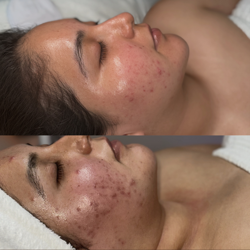 Acne Book Camp facial at 222GLOW AESTHETICS in Vacaville, CA