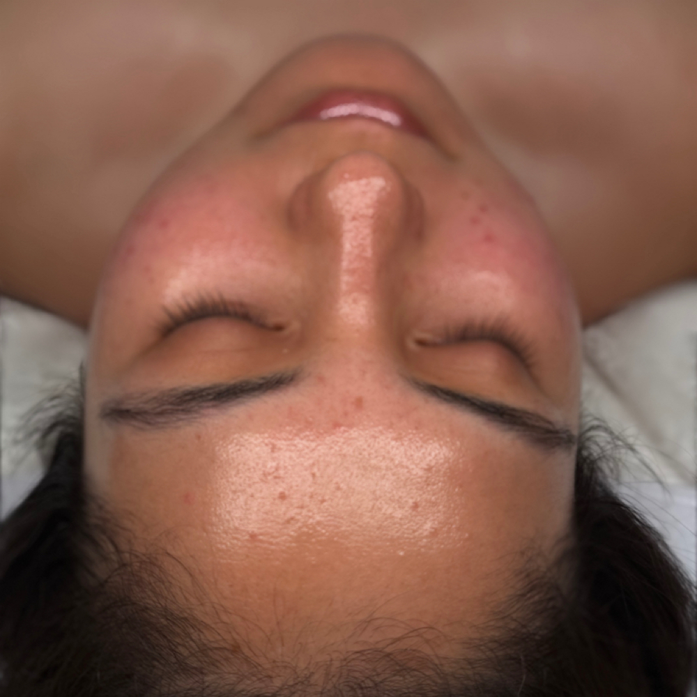 Acne Book Camp facial at 222GLOW AESTHETICS in Vacaville, CA