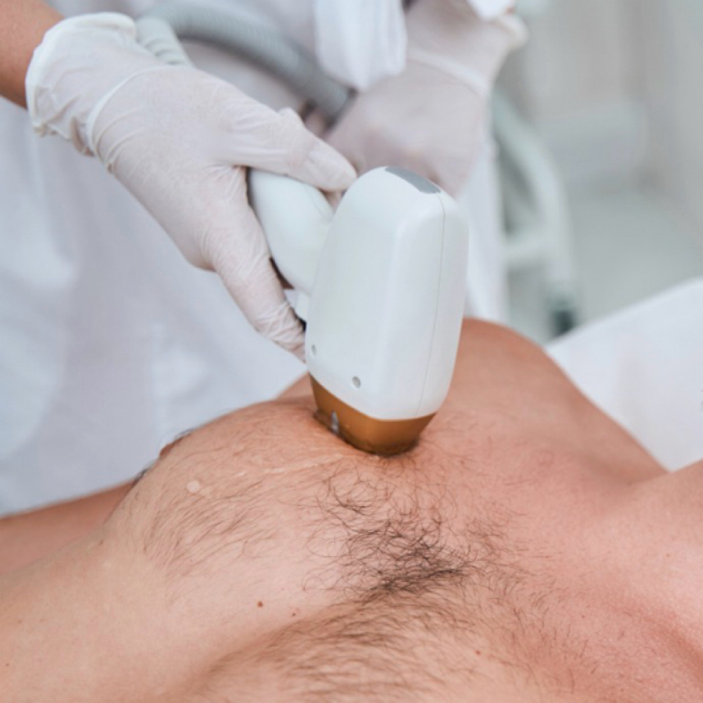 Areola Laser - 5 Sessions at Blessed & Bare Laser Studio in New York, NY