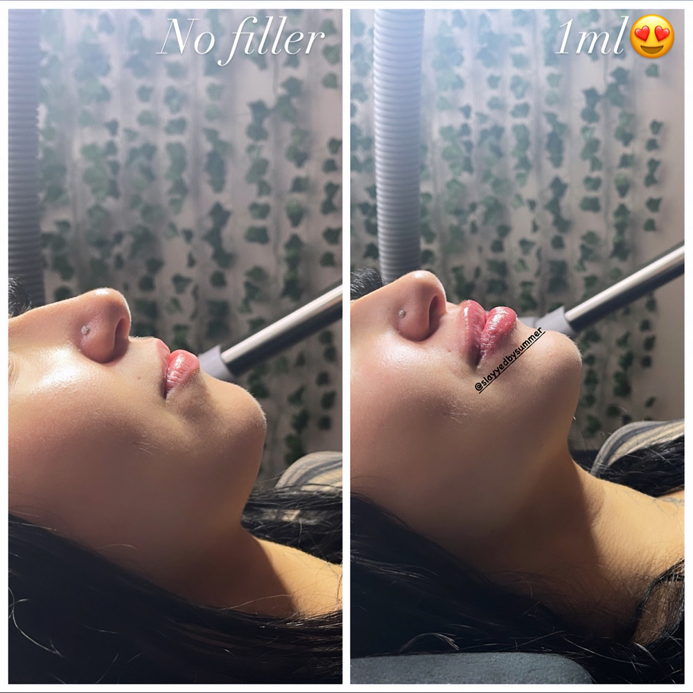 ✨One Syringe Of Hylauron Filler✨