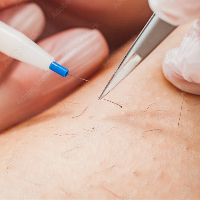 120 minute Electrolysis Treatment at Accentuated Beauty Spa in Salisbury, NC