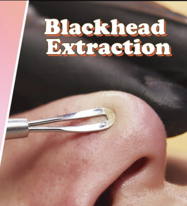 Black Head Extractions