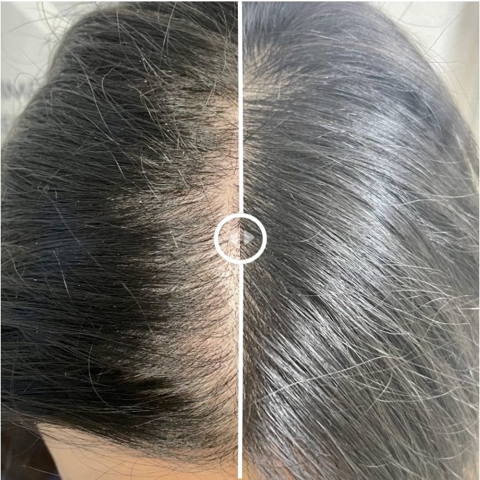 Keravive Full Scalp Hydrafacial