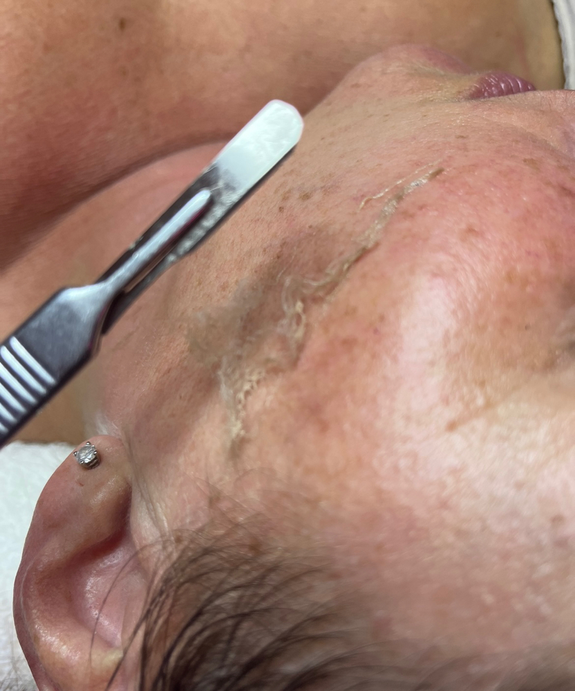 Dermaplane Facial