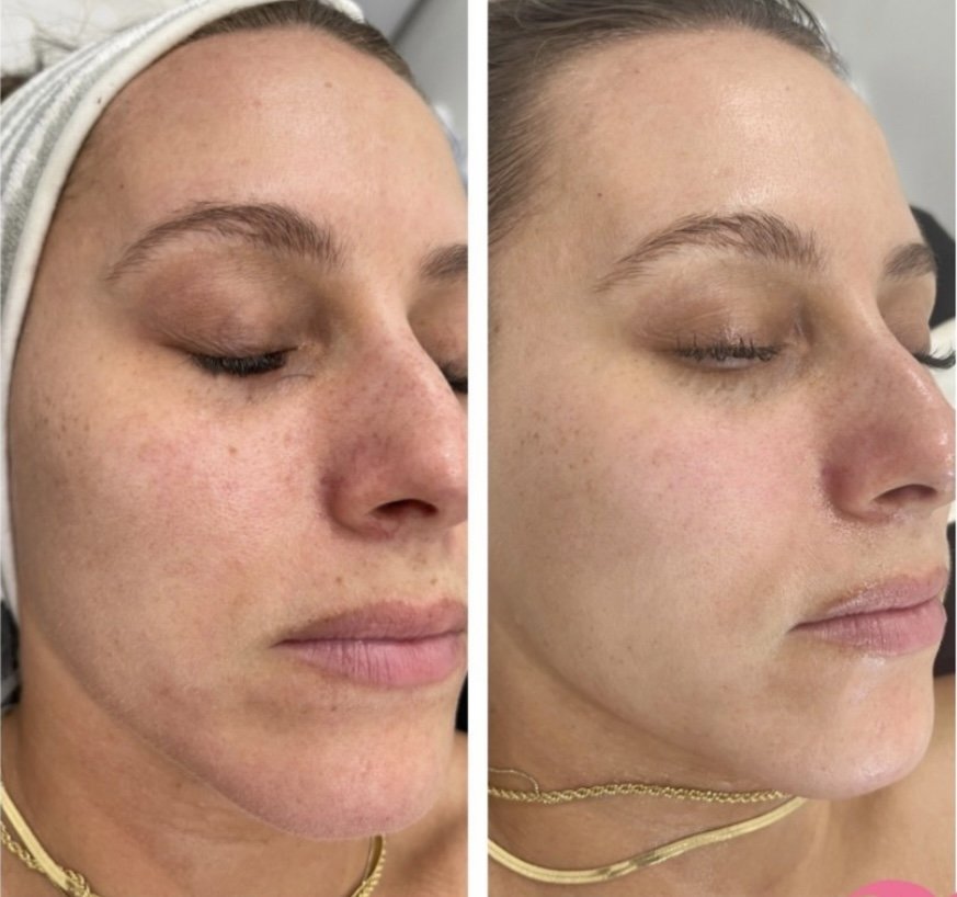 Hydrodermabrasion facial