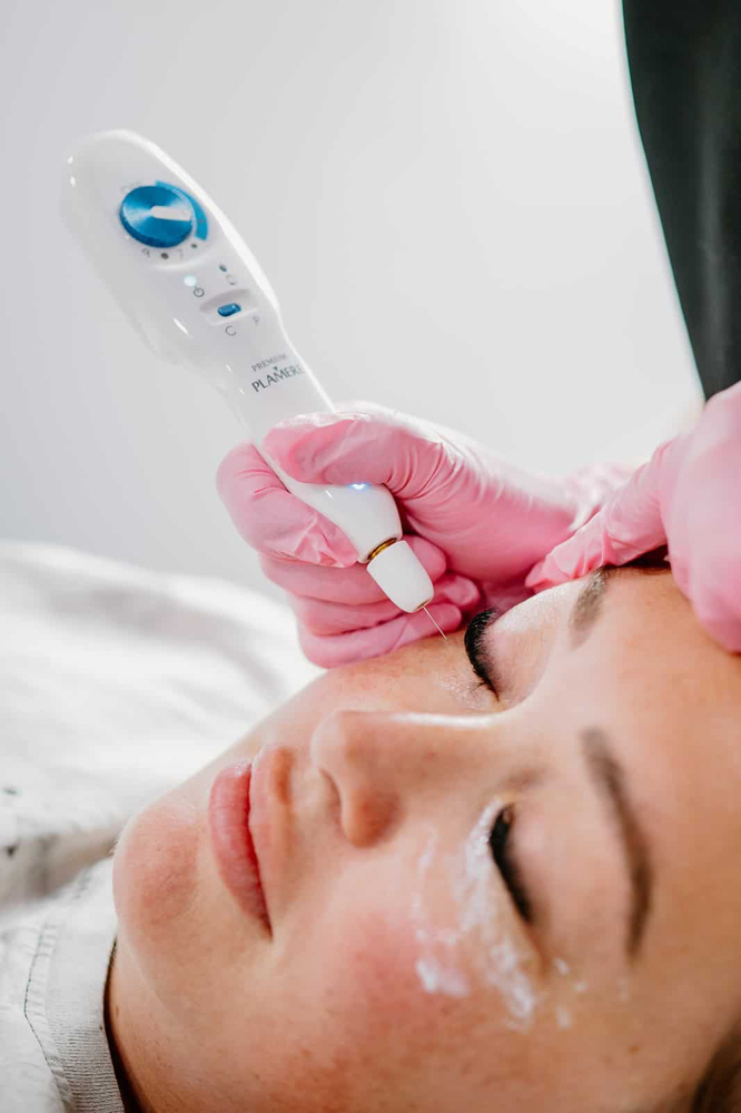 Face Lift | Fibroblast Plasma Pen