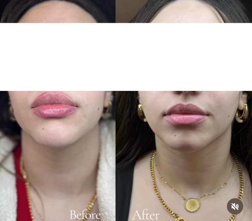 Masseter (Jawline Tox)