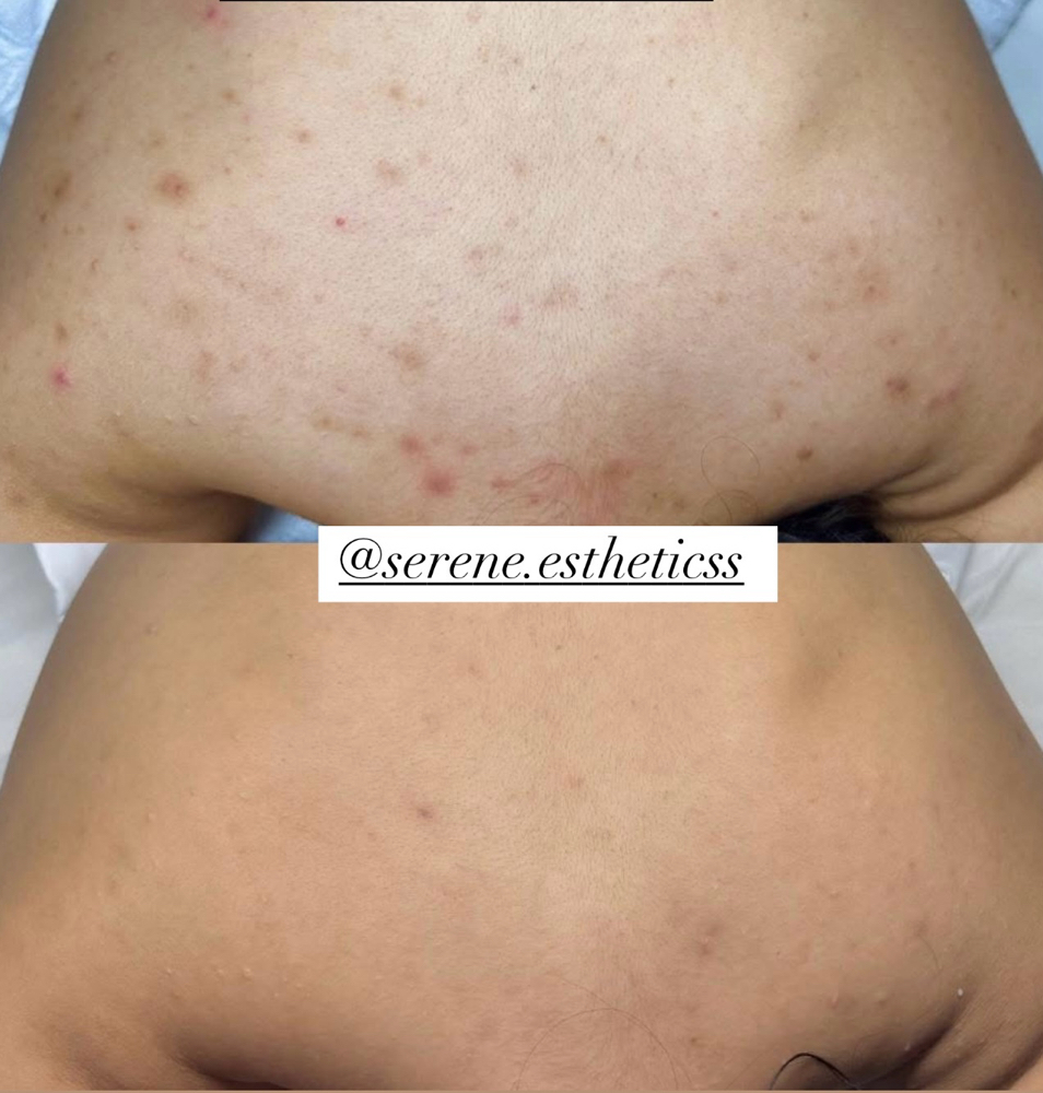 Biorepeel Gold For body at Serene.Esthetics in Franklin Square, NY