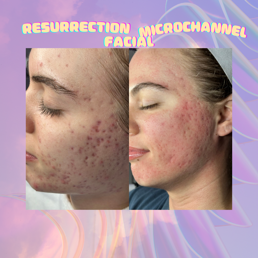 🧛Resurrection Microchannel Facial