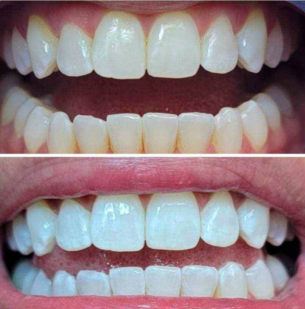 60 min Teeth Whitening