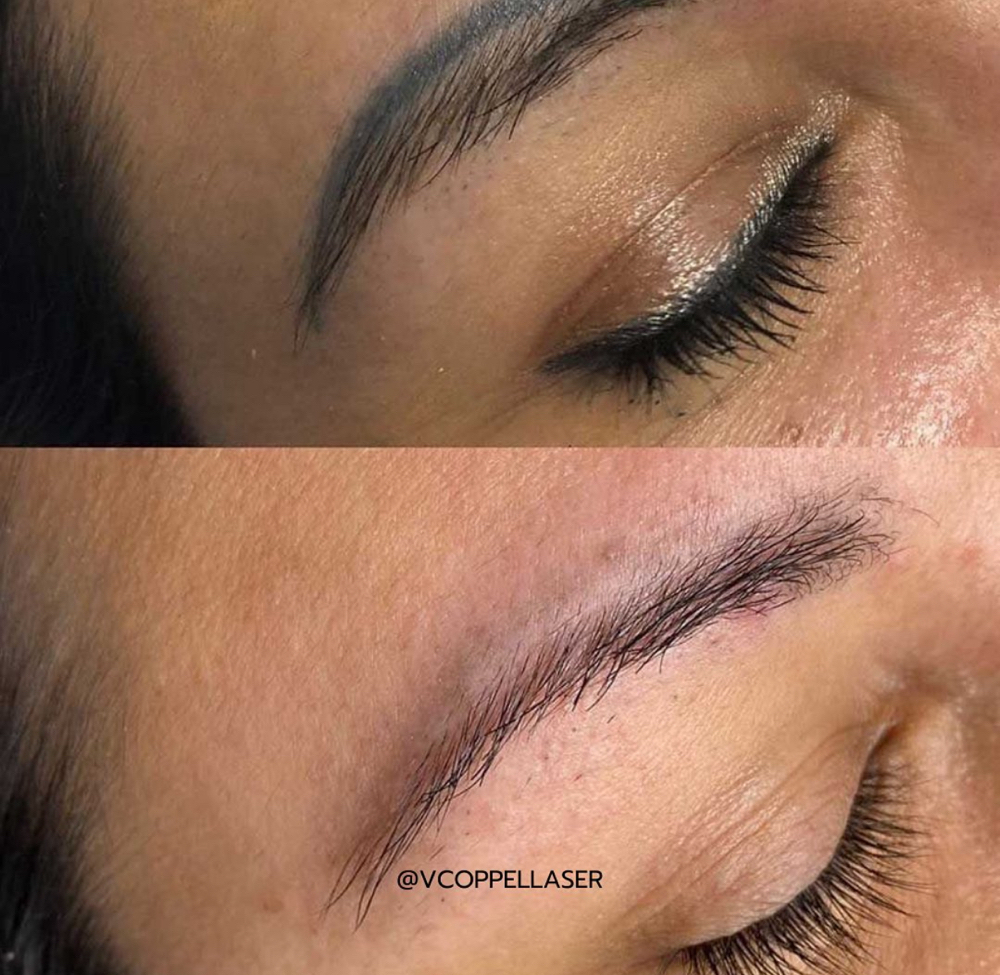 Microblading Removal P/session