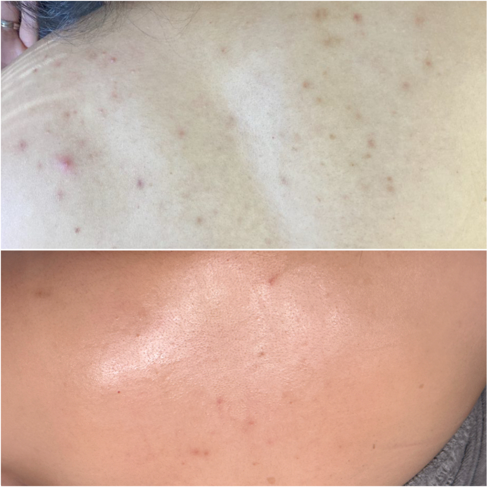 Back Treatment at Phe Michelle Beauty in Texarkana, TX