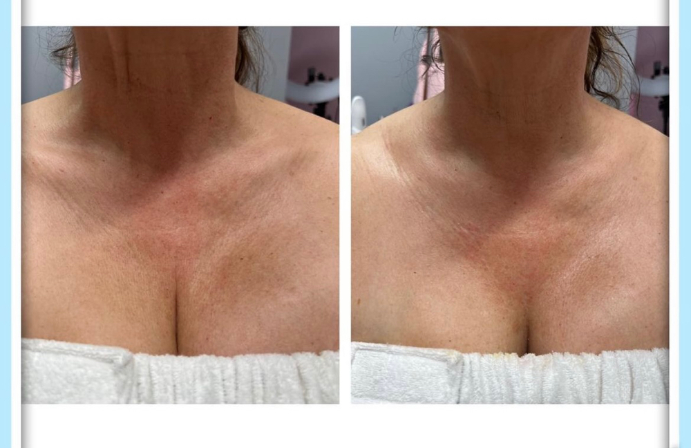 Neck & Chest Treatment