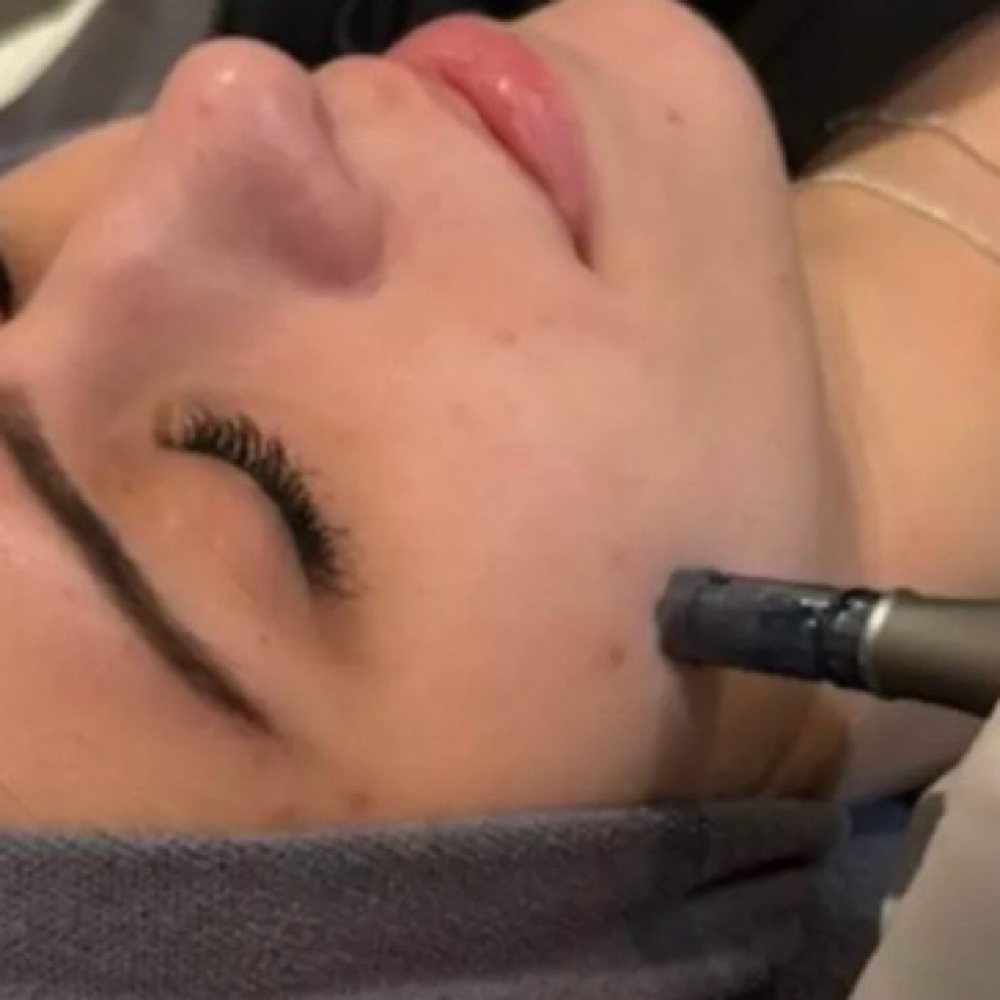 Nano-Needling Face at Kate McNally Skin Care, LLC. in Eden Prairie, MN