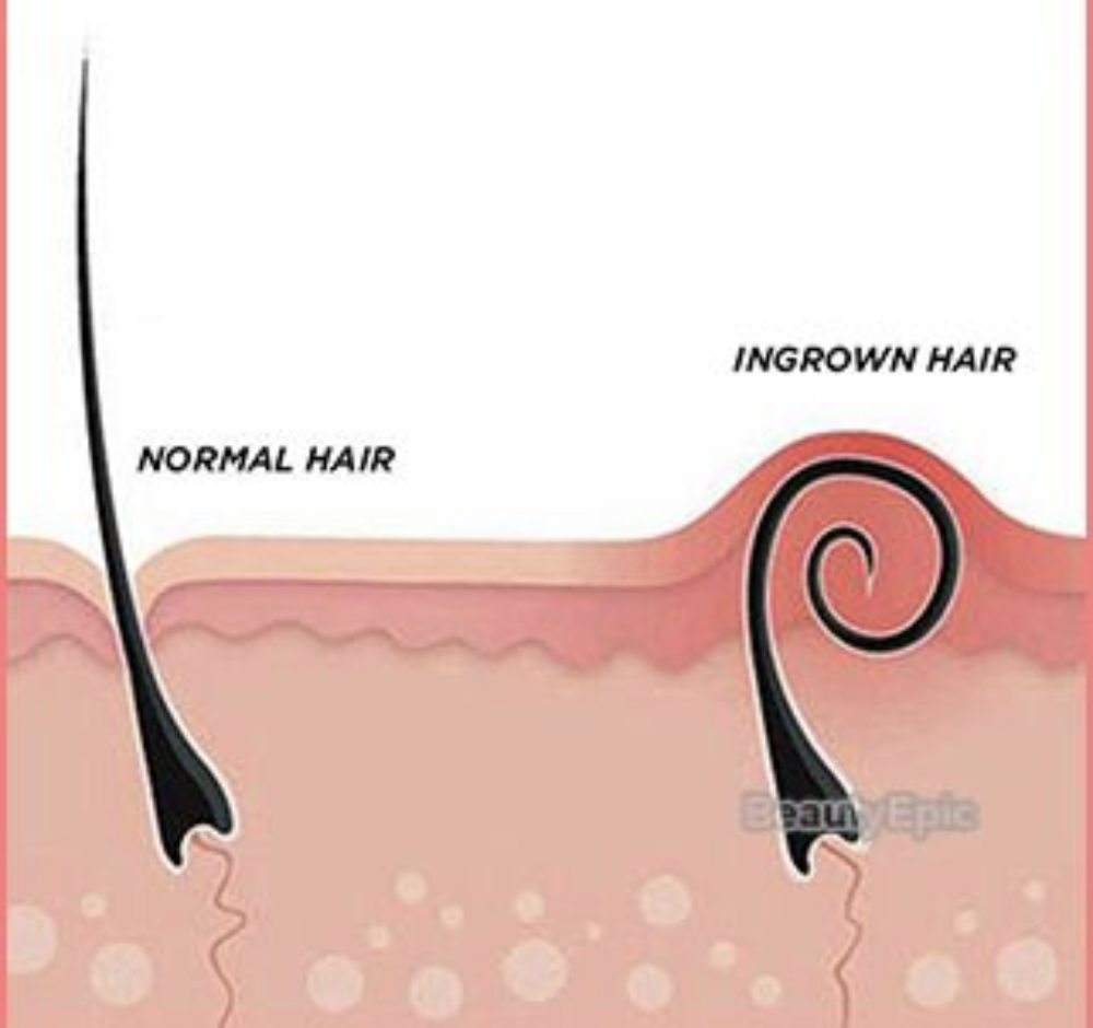 Ingrown Hair Treatment