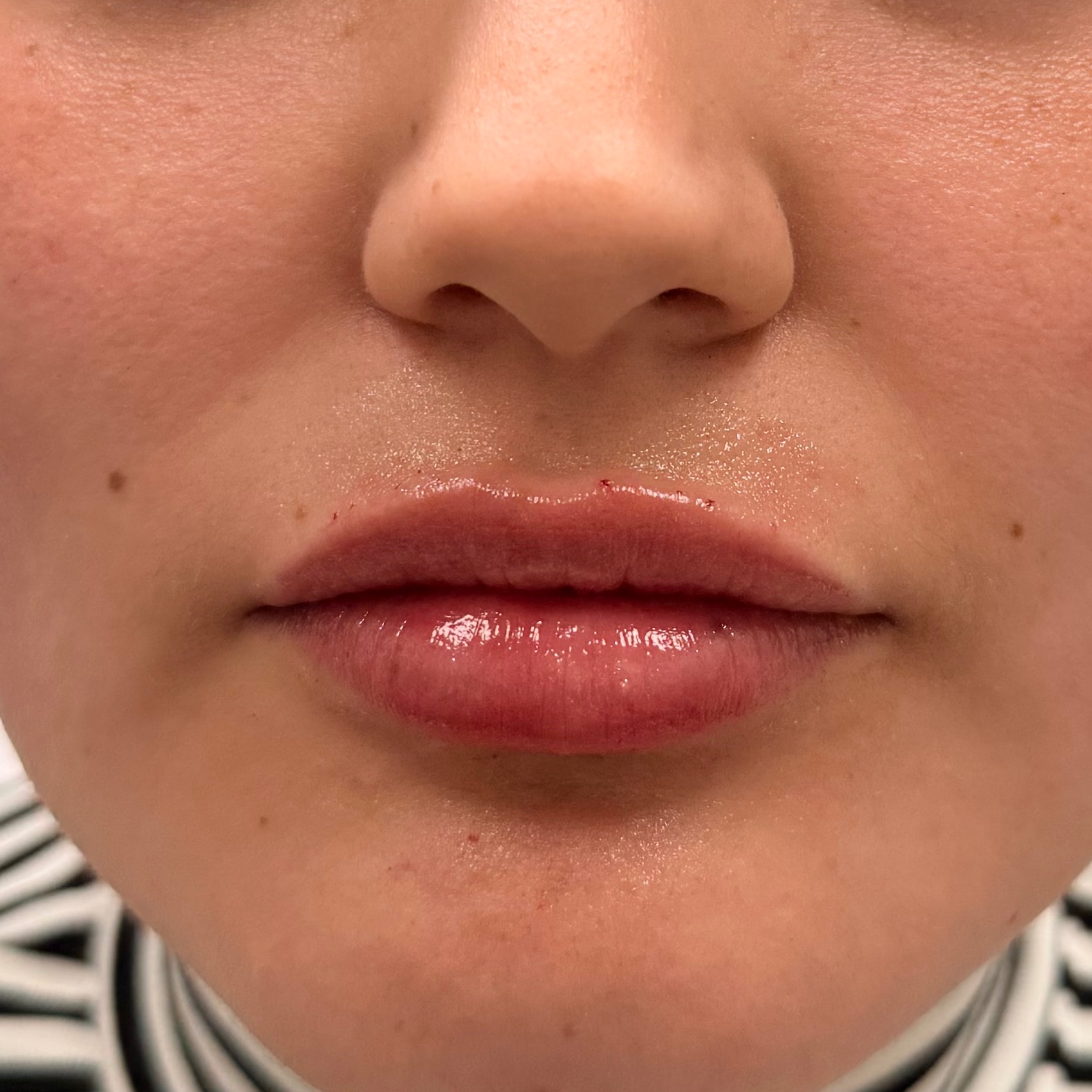 Mini Plump (1/2 syringe) Juvederm at Radiant Aesthetics by Liz in El Paso, TX