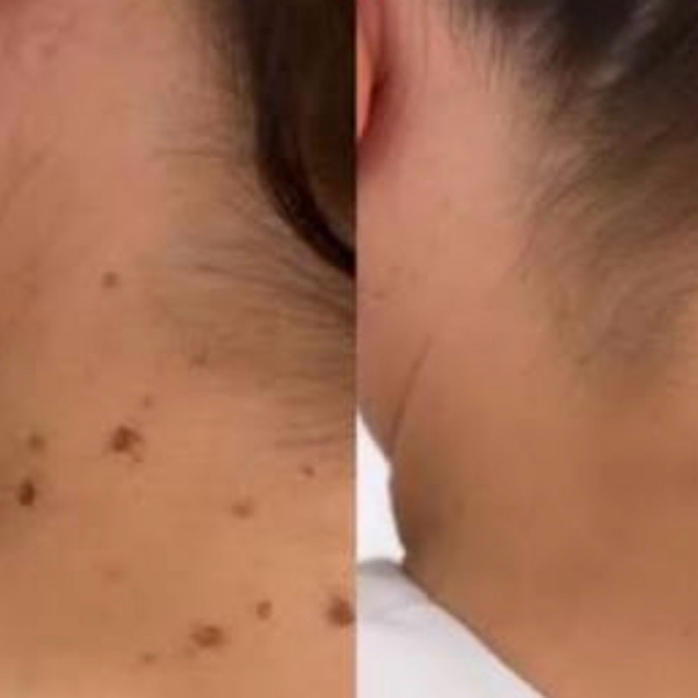 Skintag Mole Removal (1-3) at Spatium Urgent Care & Wellness in Marietta, GA