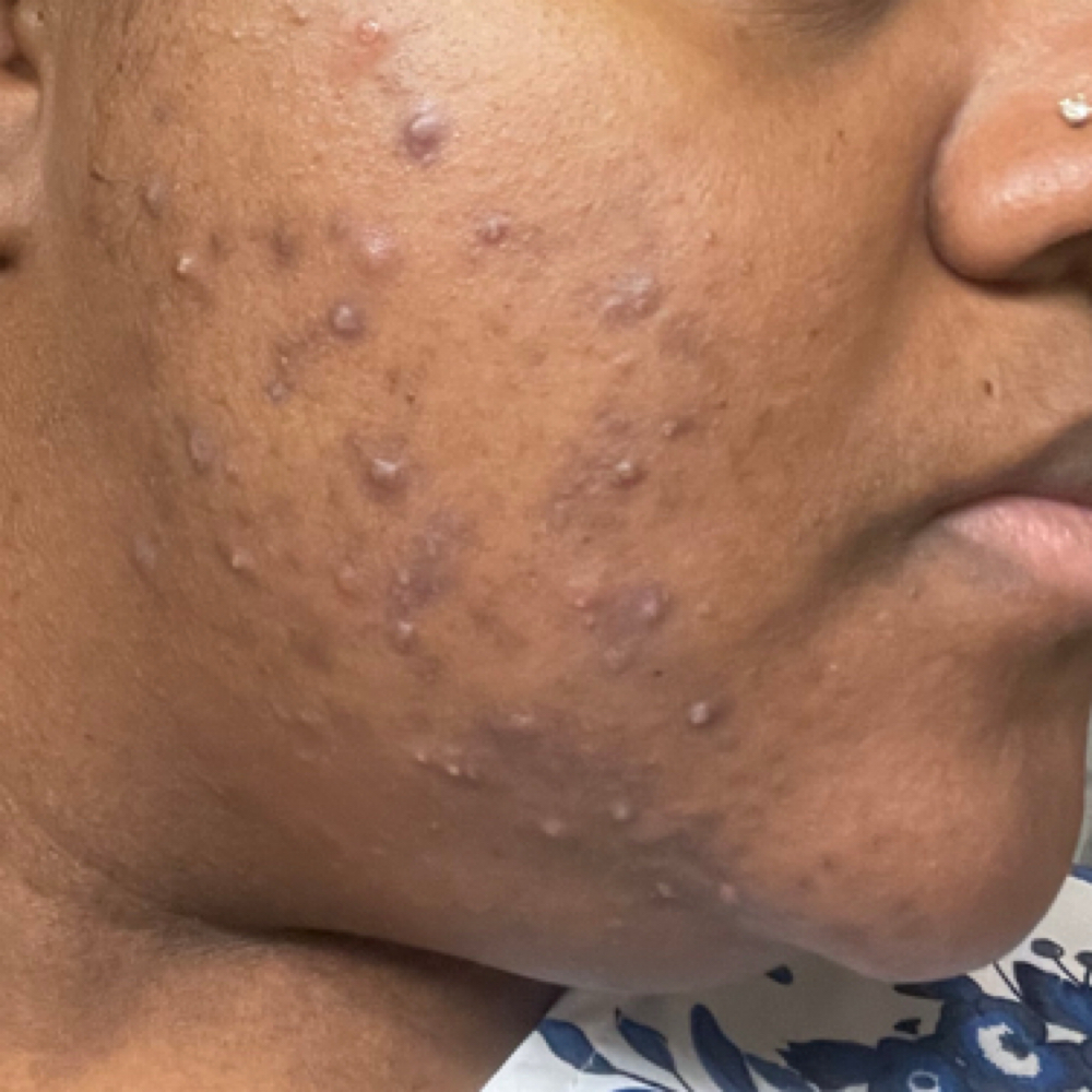Acne Facial at Haven Essentials Co. in Lake Elsinore, CA