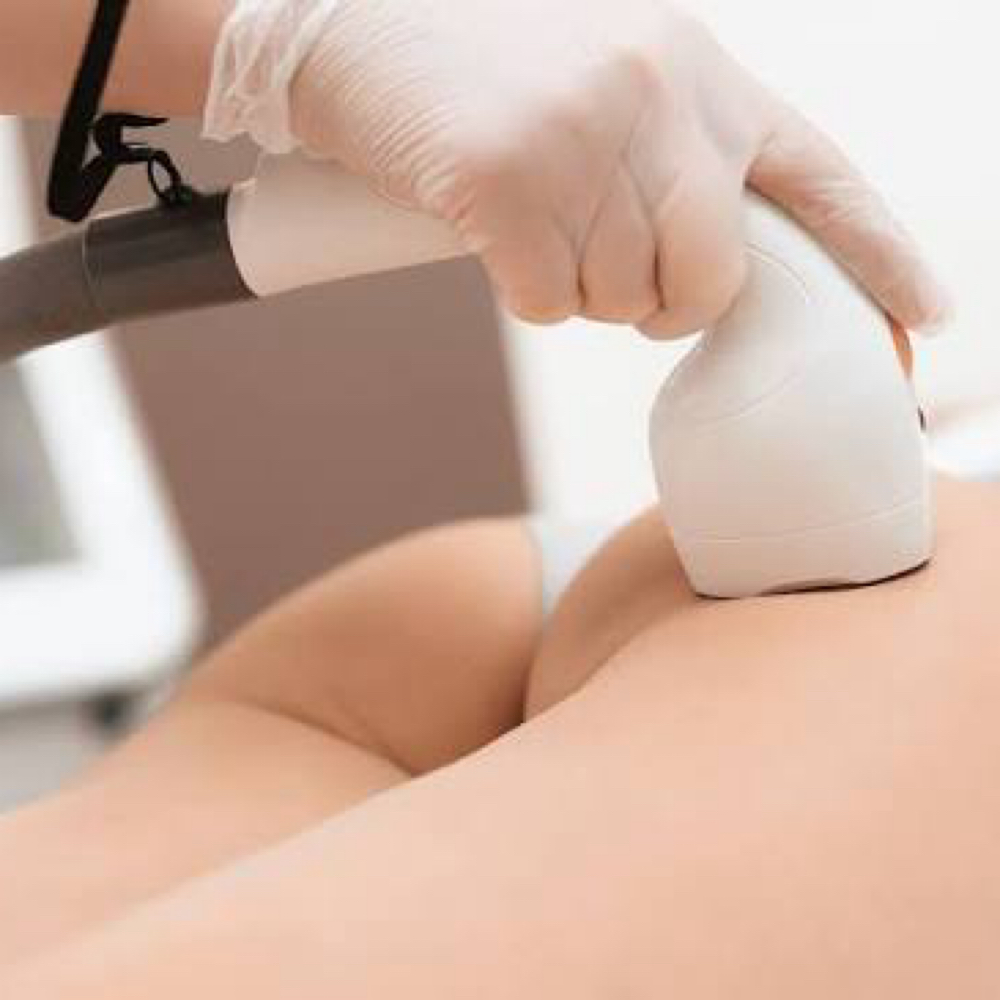 Laser Hair Removal (Buttocks Area)