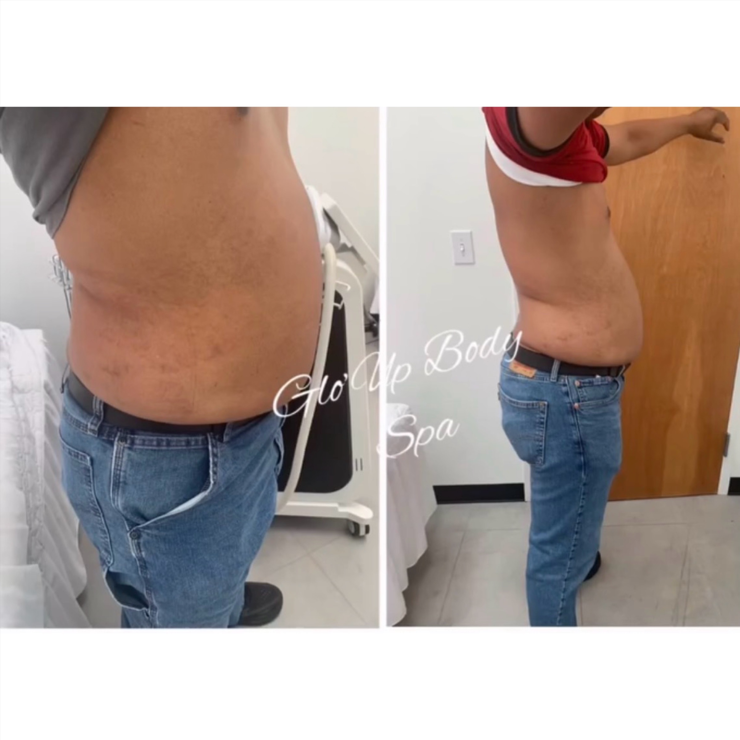 Fat Dissolve Injections at Glo'Up Body Spa in Atlanta, GA